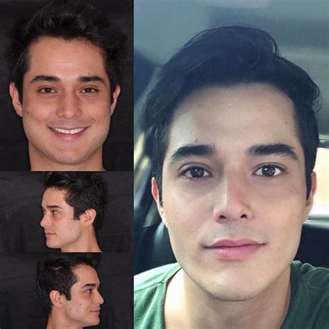Recientemente se ha puesto de moda y todo el mundo habla de las bolas de bichat o bichectomía como el tratamiento estrella utilizado por las celebrities para estilizar el rostro y realzar sus pómulos. Bichectomia: saiba tudo sobre o procedimento - Tudo Ela