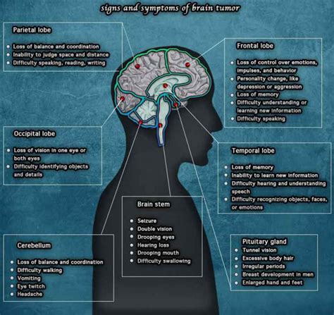 10 Warning Signs And Symptoms Of Brain Tumors You Should Know