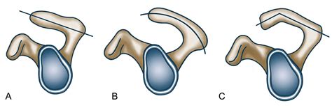 The clinical significance of variations in acromial morphology. Orthoforum Rotatorenmanschettenruptur