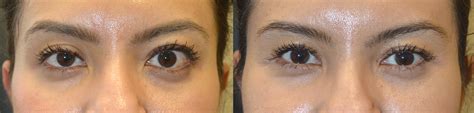 The eyelids and membranes may retract as they swell. Graves Disease Before After Thyroid Eye Photos Los Angeles