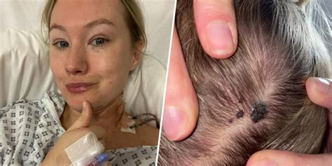 Skin Cancer On Womans Scalp Diagnosed As Fungus It Was Melanoma