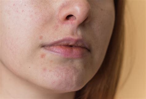 Dark Spots Around The Mouth 9 Home Remedies Emedihealth