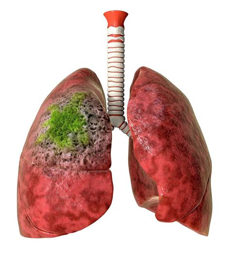 Lung Cancer Animation