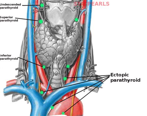 Anatomy Head And Neck Parathyroid Ectopic Glands Statpearls Ncbi