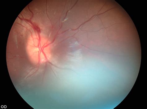 Optic Disk Swelling On Fundoscopic Examination Of The Right Eye Showing