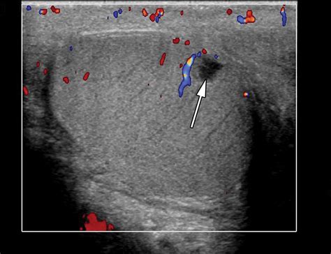 Testicular Seminoma And Its Mimics From The Radiologic Pathology