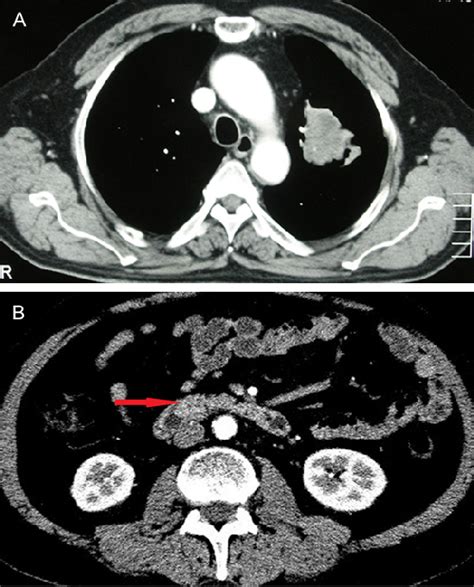 Figure 1 From A Presenting With Obstructive Jaundice In Pulmonary