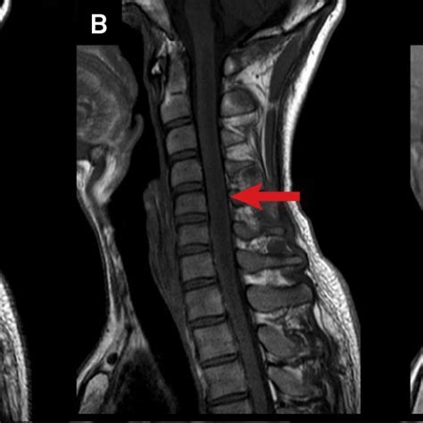 A Sagittal T2 Weighted Cervical Spine MRI Showing A Heterogeneous