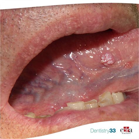 Papillary White Excrescence On The Tongue A Clinical Case Dentistry33