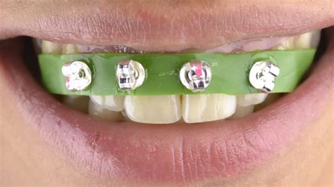 The Dangers Of Diy Braces Nofrills Dental