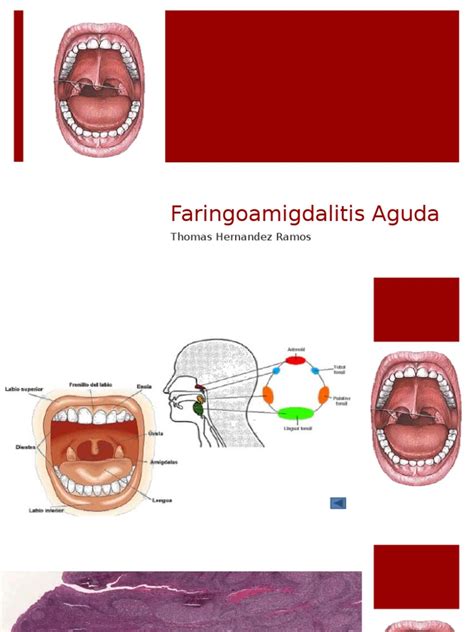 Faringoamigdalitis Penicilina Enfermedades Y Trastornos