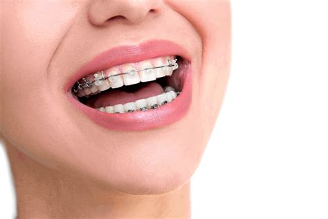 Orthodontics For Adults What Options Are Open To You As An Adult Ismiles Orthodontics