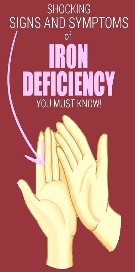 10 Signs And Symptoms Of Iron Deficiency Wellness Tips 103