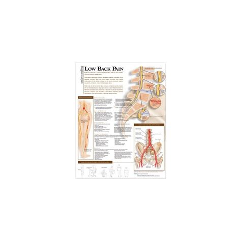 Understanding Low Back Pain Anatomical Chart Anatomical Chart Company Wolters Kluwer Health
