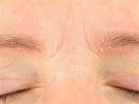 Eyebrow Dandruff Causes Treatments And Remedies