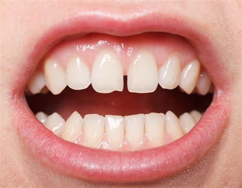 Midline Diastema Drkoya The Dentist Best Dental Clinic In Hyderabad