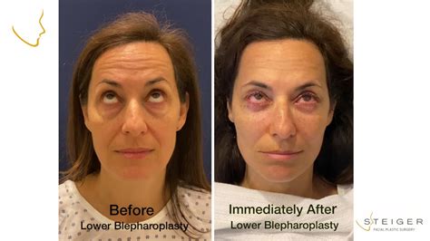 Lower Eyelid Surgery Immediate Results Blepharolplasty For Under Eye