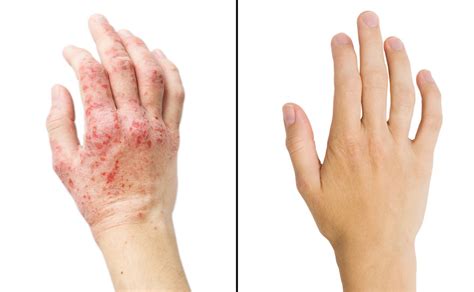 Eczema And Psoriasis Treatment In Lehigh Valley Pa