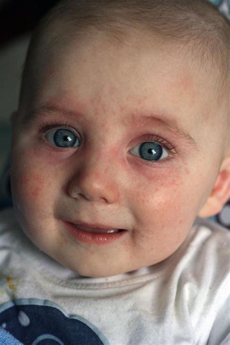 Baby Food Allergy Rash On Neck