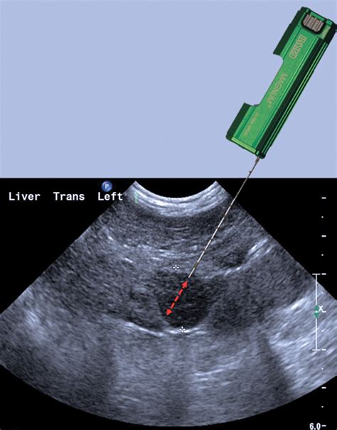 Ultrasound Guided Biopsy Of The Liver Clinicians Brief