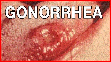 Gonorrhea in women has an incubation period that ranges from a few days to a week. How to Recognize Symptoms of Gonorrhea in Women - YouTube