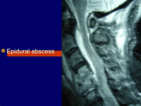 Spinal Epidural And Subdural Intramedullar Abscesses
