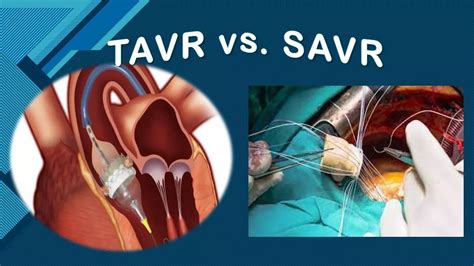 Notion Verdict Out Tavr Comparable To Savr Even After 8 Years Ehj