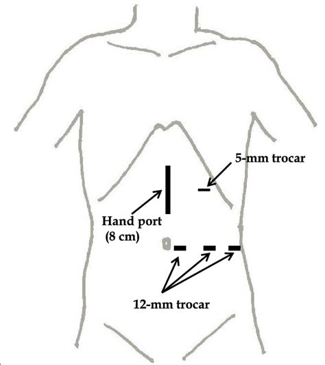 Skin Incision And Port Placement Of Hand Assisted Laparoscopic