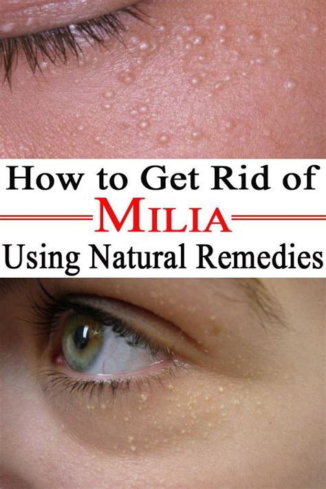 How To Get Rid Of Milia Using Natural Remedies The Beauty Depot