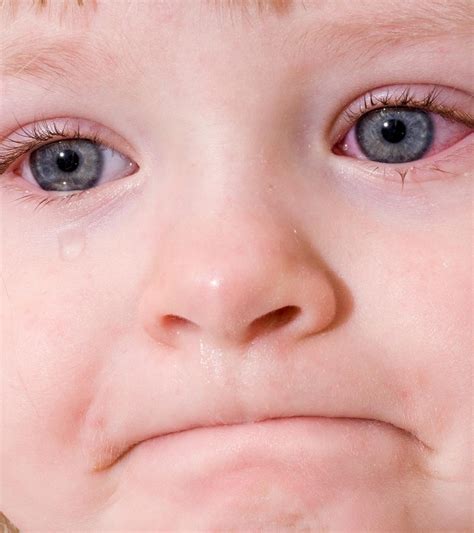 Pink Eye In Toddlers 3 Causes 8 Symptoms And 4 Treatments You Should