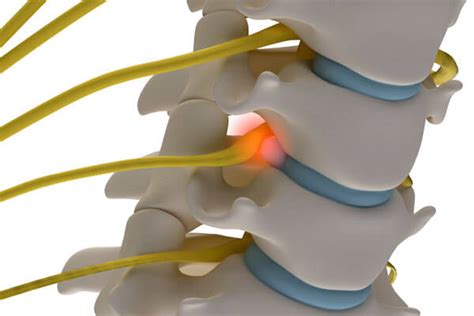 Nerve Root Compression Seddon Physiotherapy