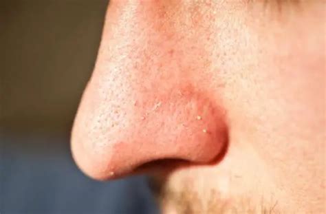 Whiteheads On Nose Causes Get Rid Of Whiteheads On Nose In Nose