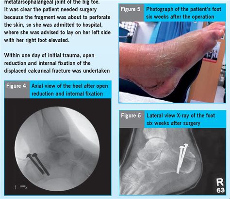 Avulsion Fracture Of The Calcaneal Tuberosity Diagnosis And Treatment
