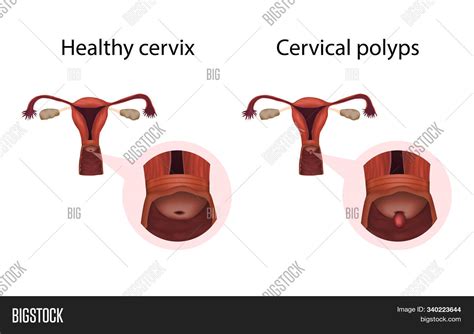 Cervix Polyps And Healthy Organ Cervical Disease Abnormal Growth Of