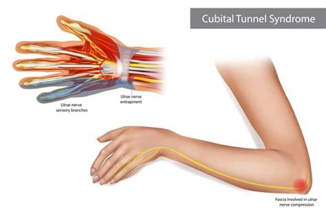 Exercises To Treat Cubital Tunnel Syndrome Nerve Gliding Exercises