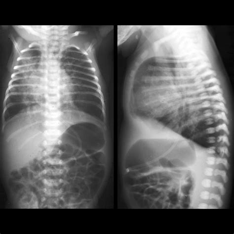 Infant With Several Episodes Of Aspiration Pneumonia In The Last Year