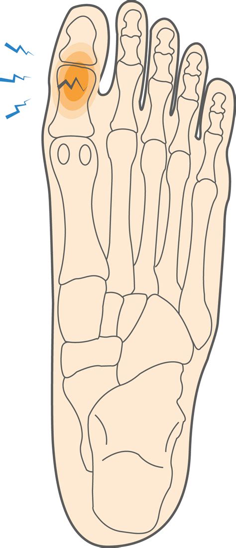 What Is A Great Toe Fracture And How To Manage This Injury Upswing Health