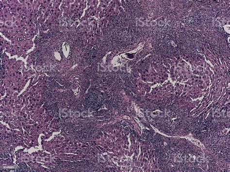 Human Pathology Foreign Body Granulome With Hemosiderin And Giant Cells