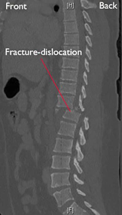 Fractures Of The Thoracic And Lumbar Spine Dr Mukhis Raj Hospital