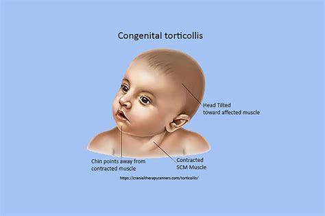 Congenital Muscular Torticollis Triumph Therapeutics