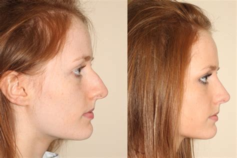 Before And After Closed Rhinoplasty Dr Andrew Denton Dr Denton