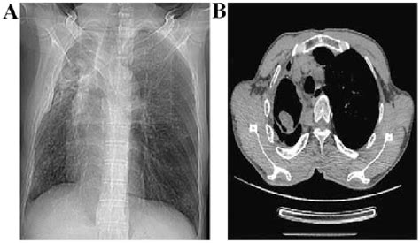 Ct Imaging Of Representative Meniscus Sign Of One Pulmonary