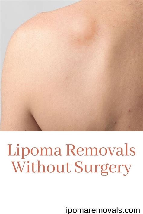 Pin On Lipoma Removal Without Surgery