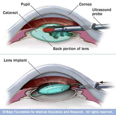General instruments may be too large and cataract surgeries vary in types, depending on the patient's condition and preferences. Cataract surgery. Causes, symptoms, treatment Cataract surgery