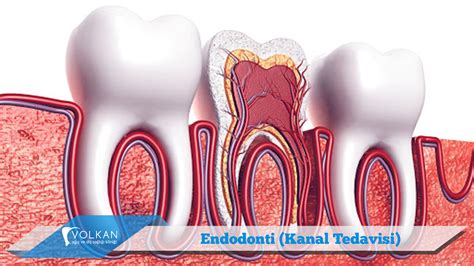 Endodonti (Kanal Tedavisi) - VOLKAN AĞIZ VE DİŞ SAĞLIĞI KLİNİĞİ