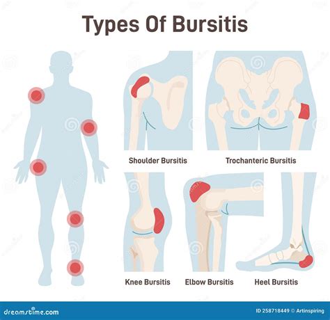 Types Of Bursitis Set Shoulder Hip Heel Knee And Elbow Joints