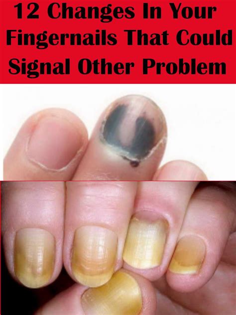 Pin By Harriet Hoskins On Daily Health And Fitness Nail Symptoms