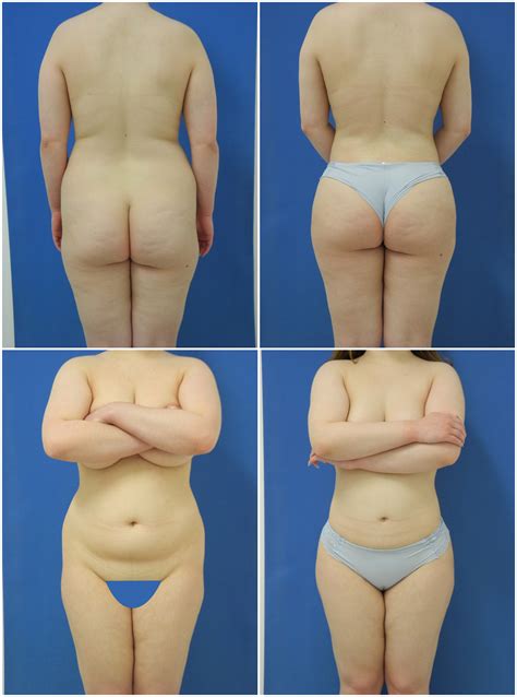 Brazilian Butt Lift Dr G Cosmetic Surgery