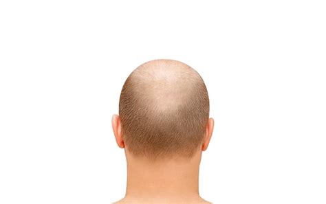 Premium Photo Male Head From Back Of Head Sparse Hair And Receding