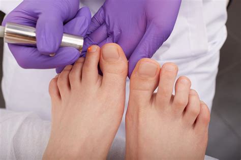 Laser Therapy For Fungal Toenails Aloha Foot And Ankle Associates